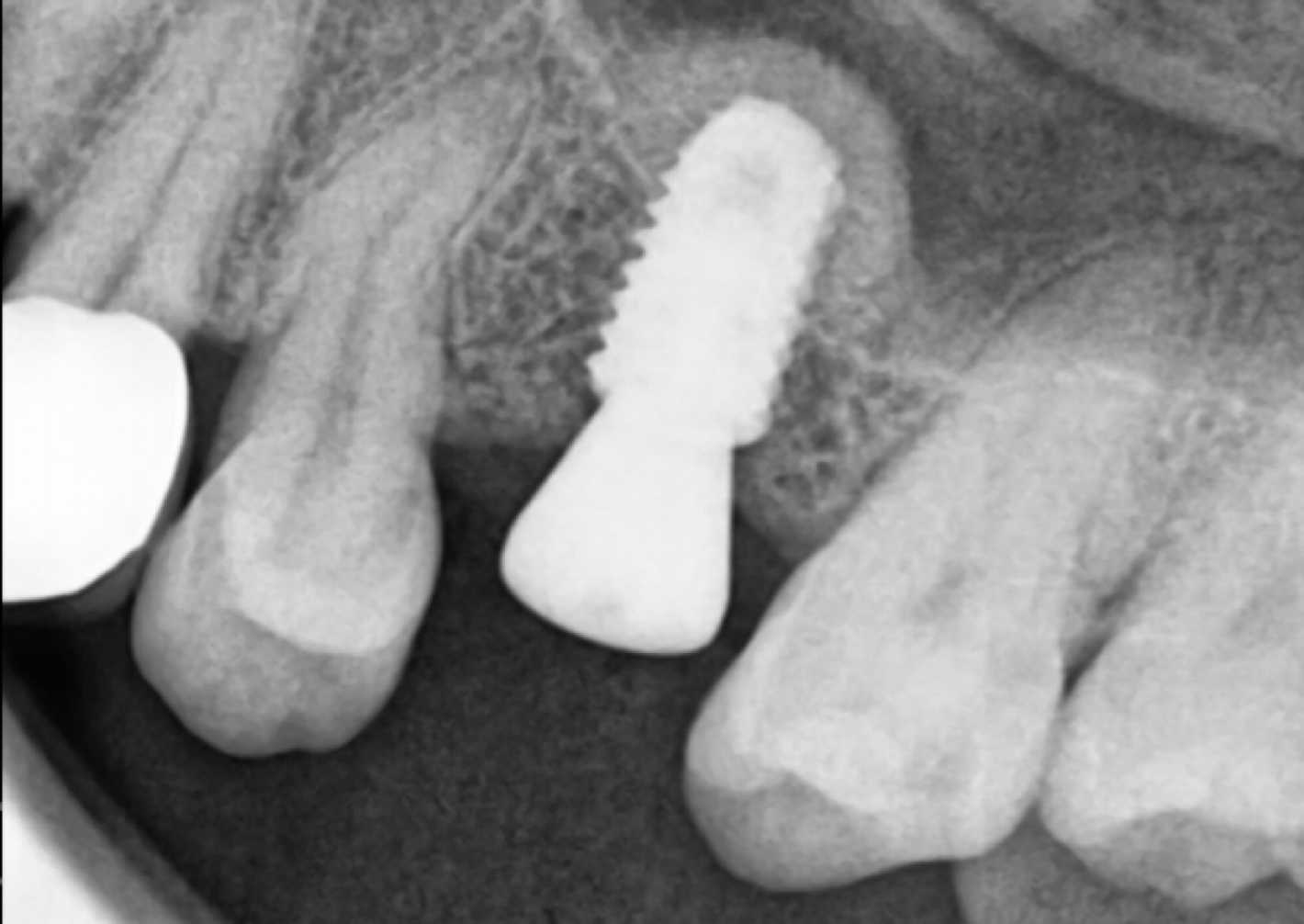 Implant Procedure Steps 1-5