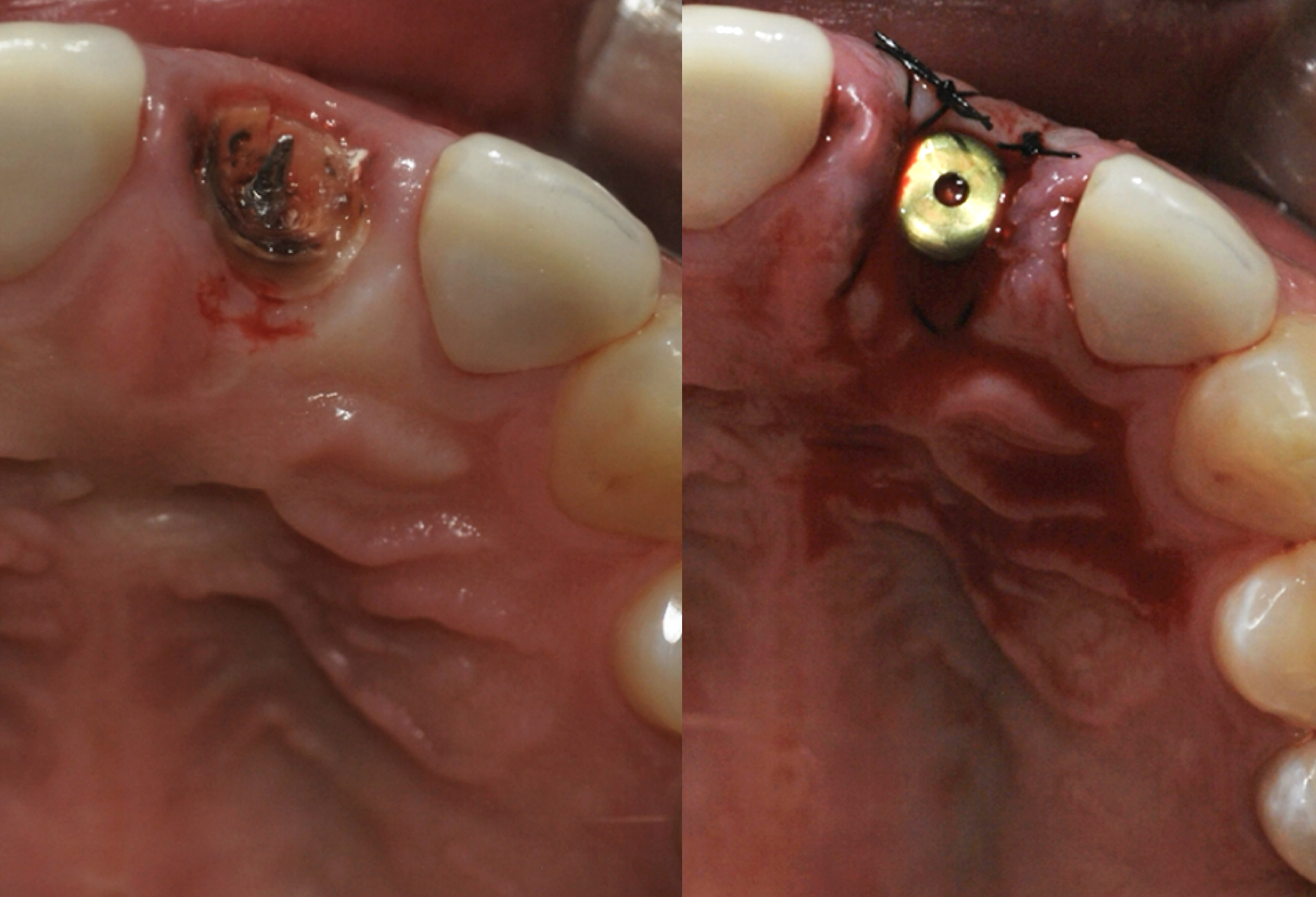Dental implant in jawbone