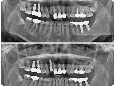 Dental X-ray after procedure 1