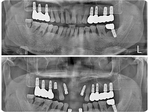 Dental X-ray after procedure 2