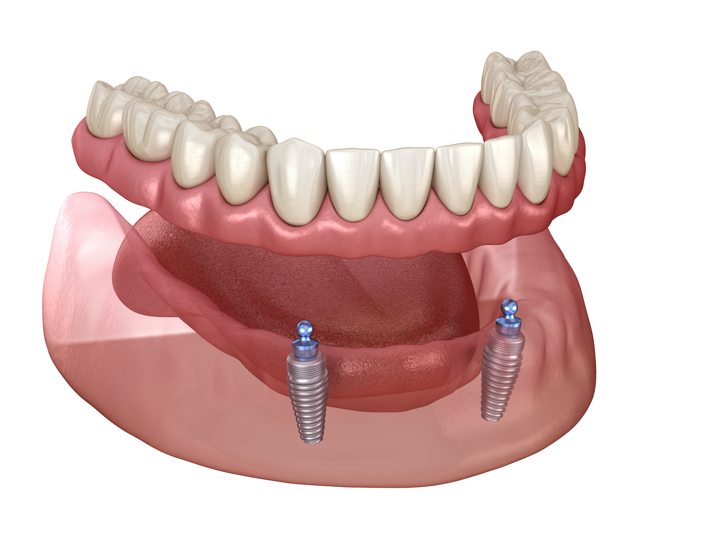 Implant Procedure Steps 1-5