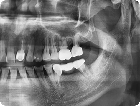 Dental X-ray after procedure 1