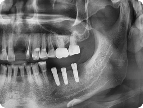 Dental X-ray after procedure 2