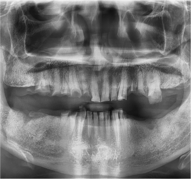 치아 파노라마 X-ray 이미지
